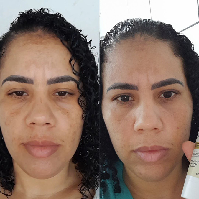 Resultado obtido por outra pessoa usando o Clareador NutralFit